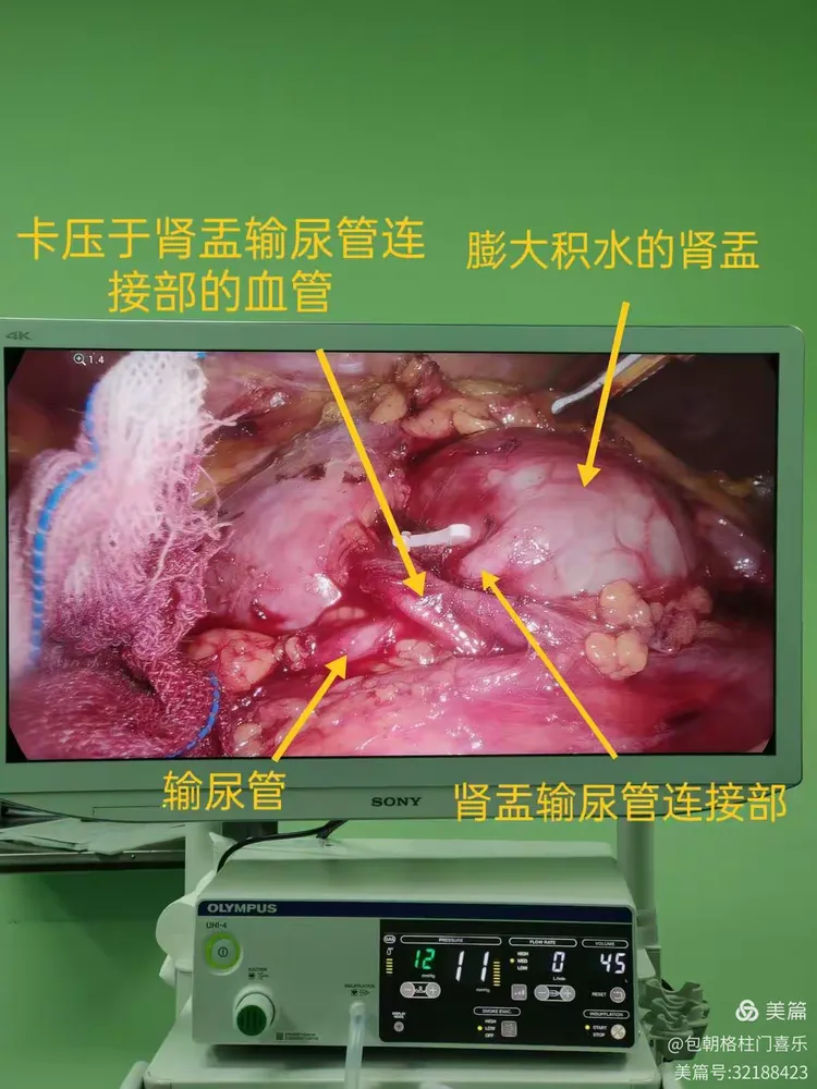 肾盂输尿管连接部狭窄之腹腔镜下成形术
